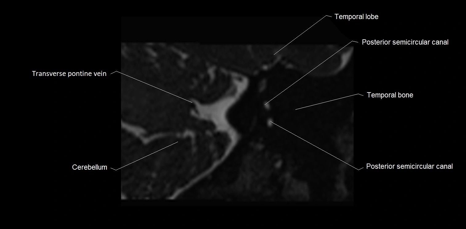 Internal auditory meatus (IAM) axial cross sectional anatomy image 31.webp